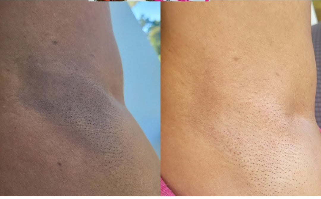 Inner Thighs and Armpits Lightening Combo